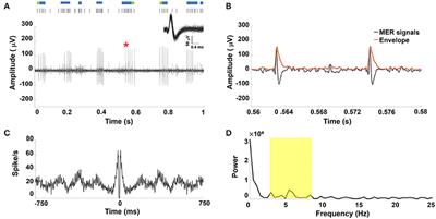 Decreased Power but Preserved Bursting Features of Subthalamic Neuronal Signals in Advanced Parkinson's Patients under Controlled Desflurane Inhalation Anesthesia